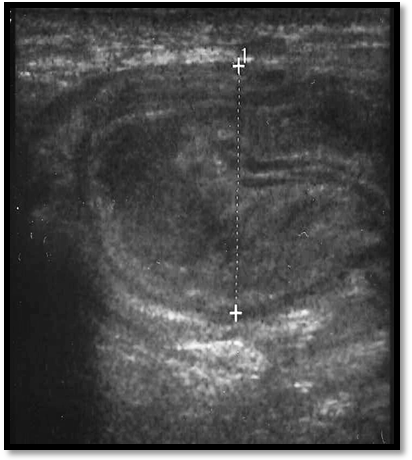 Ультразвуковая диагностика бедренной грыжи, фото